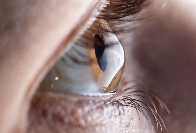 The exact causes of keratoconus are not known.