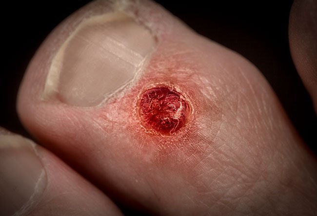 How Do You Get Rid of a Myxoid Cyst