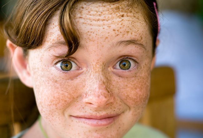 Dark spots on your face