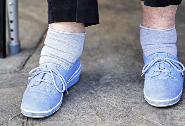 Your swollen feet and ankle treatment will most likely be for the condition that is causing the swelling instead of the swelling itself.