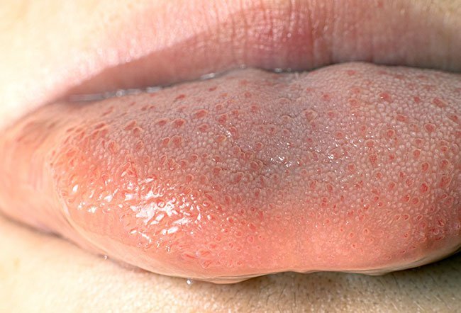 Transient lingual papillitis is the small, painful, reddish-white bumps or spots on the tongue