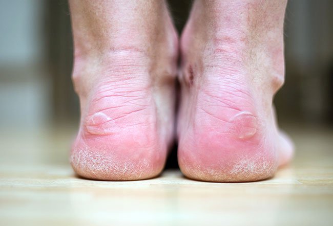 Blisters are small fluid pockets of clear fluid that form in the superficial skin layers.