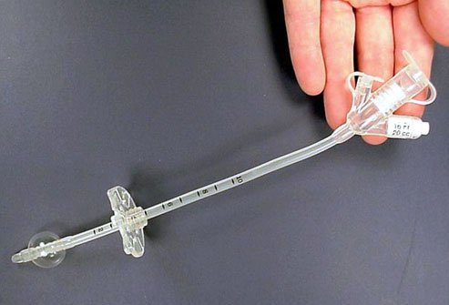A gastrostomy tube (G-tube) feeds nutrition or medication into the abdomen.