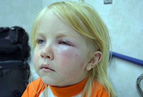 Swollen eyelid