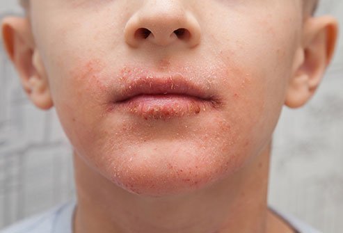 Perioral Dermatitis