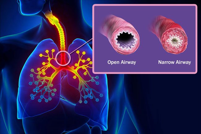 During an asthma attack, the airways in and out of your lungs narrow and your body makes extra mucus, both of which make it hard for you to breathe.