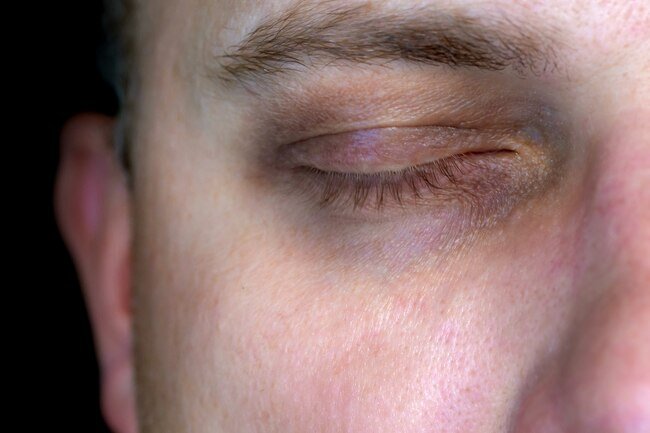 Alcohol use may give you dark circles under your eyes.