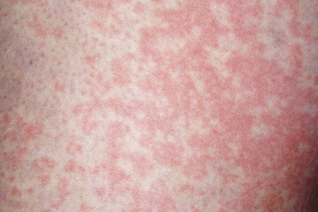 Hives may occur from drinking due to allergies or alcohol intolerance.