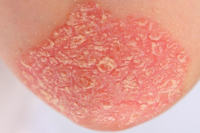 Heavy drinking may trigger psoriasis or make existing psoriasis worse.
