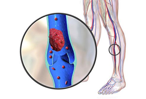 Blood clots are more common in taller people.