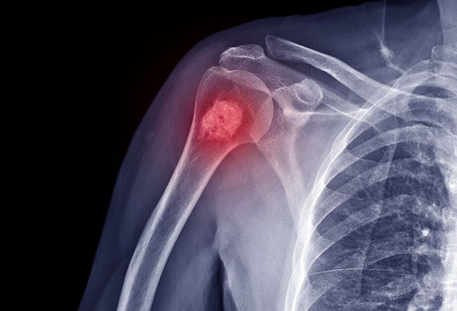 An aneurysmal bone cyst is a rare, non-cancerous tumor found in less than 1 in 100,000 children and adolescents per year. It is treated with a variety of surgical and nonsurgical measures.