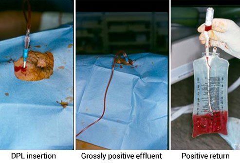Peritoneal Lavage