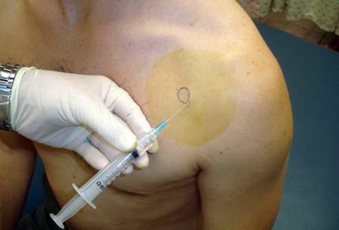 A shoulder arthrocentesis is a relatively quick procedure