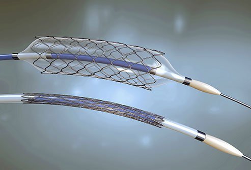 A biliary stent is a tube surgically placed to keep the bile duct open.