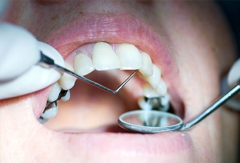 Dental fillings last for various lengths of time depending on the material.