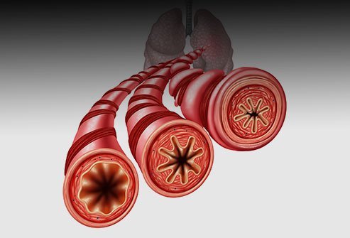 Bronchial thermoplasty is a procedure to heat and destroy some of the muscle lining the bronci, or airways into the lung. This prevents the bronci from spasming as much, preventing asthma attacks.