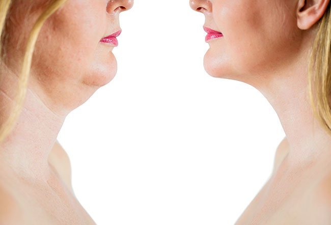 The results of Kybella may last for years because the fat cells are completely destroyed.