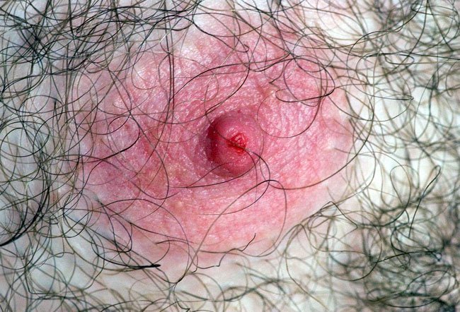 nipple fissure
