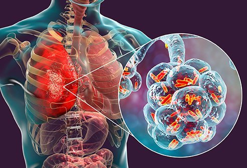 Do All Patients With COVID-19 Get Pneumonia