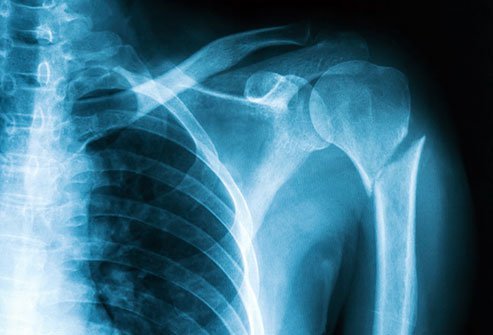 A fractured humerus or upper arm is extremely painful