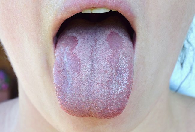Typically, your doctor will prescribe an antifungal medicine to get rid of a yeast infection. The medication should resolve within one to two weeks.