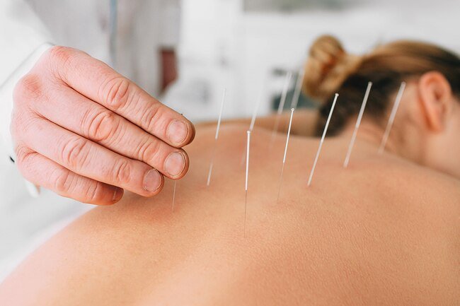 If you have atrial fibrillation AFib acupuncture might just work.