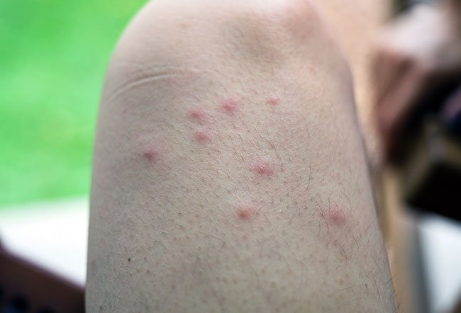 Does Toothpaste Help Mosquito Bites