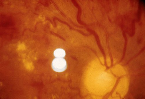 An eye doctor can check your eyes for damage during an eye exam.