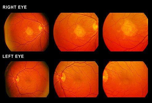 There are two types of macular degeneration.