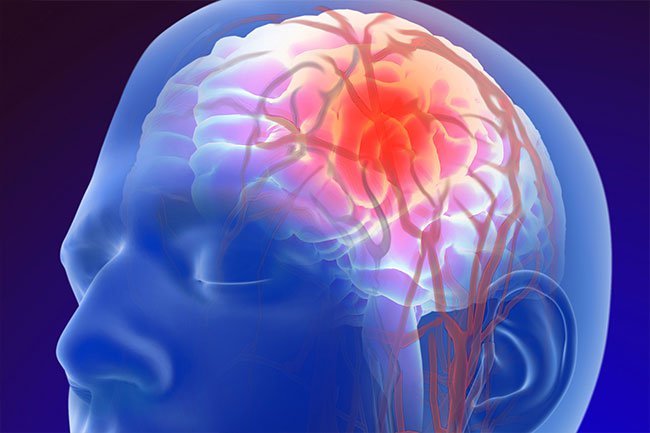 Type AB tends to clot more than other types, increasing the risk for stroke.