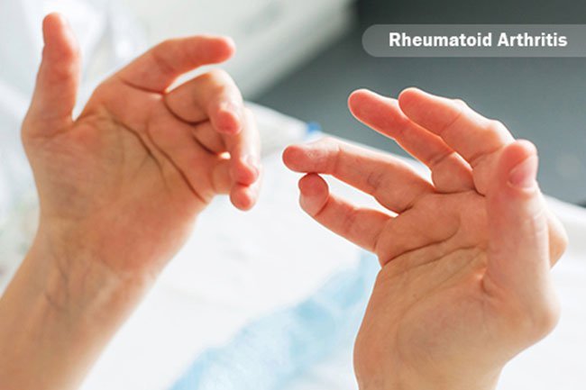 A weakened immune response is known as an immunodeficiency disorder.