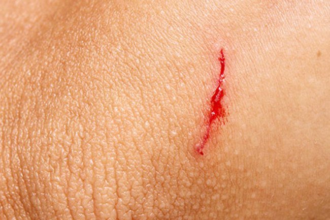 Keep cuts clean, dry, and bandaged to help prevent skin infections.