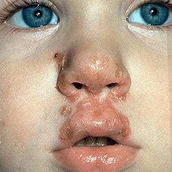 A boy suffers from impetigo.