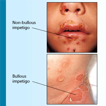 Examples of nonbullous (left) and bullous impetigo (right).