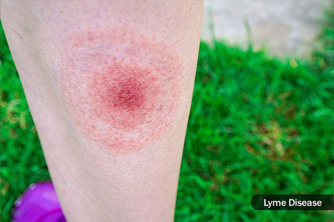 Infected ticks may harbor Lyme disease or Rocky Mountain spotted fever or viruses.