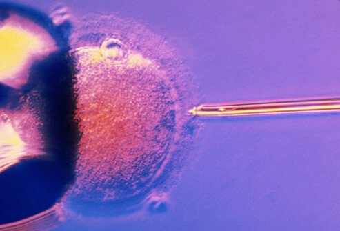 When problems have been identified with a man's sperm, a procedure called intracytoplasmic sperm injection (ICSI) may be recommended along with IVF.