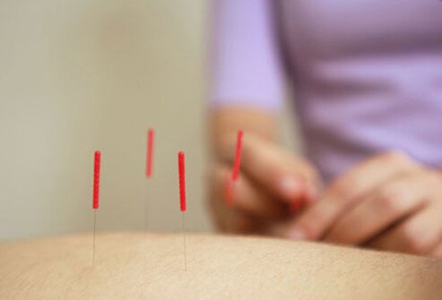 An acupuncture treatment.