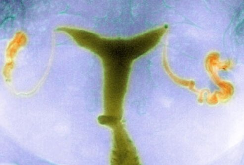 Blockage or scarring of the Fallopian tubes prevents pregnancy in some women.