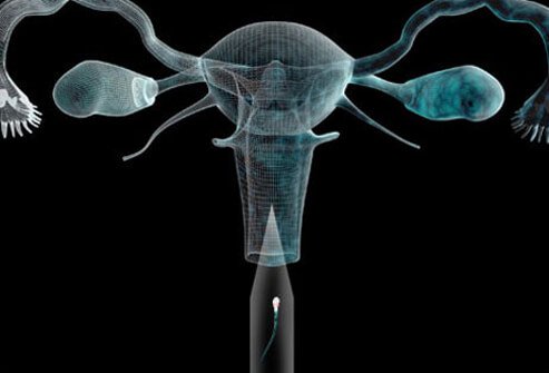 Intrauterine insemination (IUI) is used to treat different kinds of infertility.