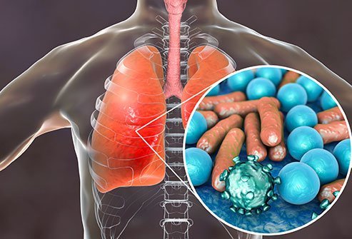 inflammation of the lungs