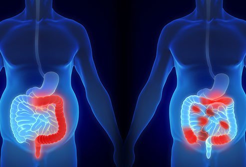 Rheumatoid Arthritis and IBD