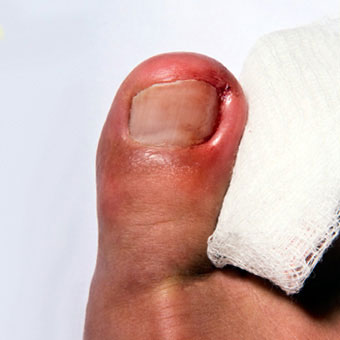 Symptoms of an ingrown toenail can include swelling, pus, and redness.