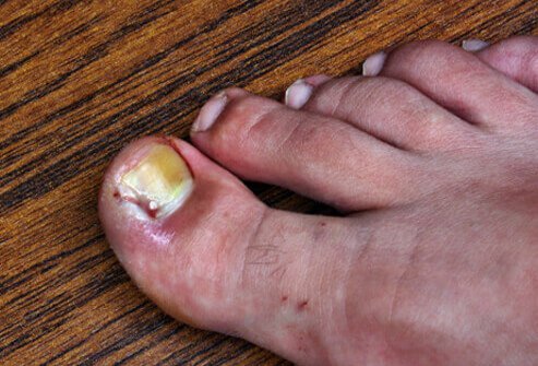 Ingrown toenails cause redness and swelling around the affected toe area.