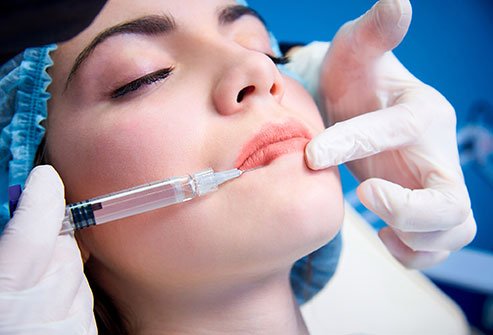 Facial fillers, as the name implies, are injections to fill out wrinkles, lines or hollows in the face due to aging.