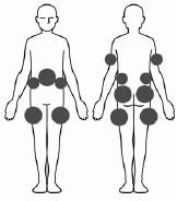 Injecting IPLEX - illustration 1