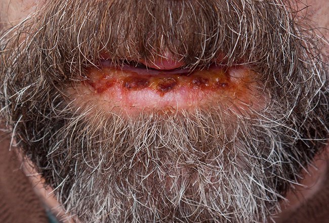Lip biopsy can be painful at times. 