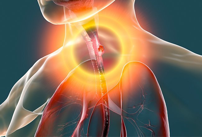 Barrett's esophagus is a condition in which the esophagus is damaged due to acid reflux. It is a serious condition that may progress to cancer of the esophagus.