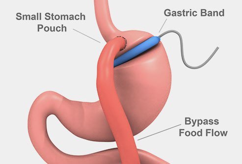 Gastric banding is a surgery to reduce the size of the stomach and help patients lose weight.