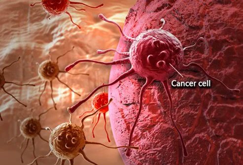 Multiple myeloma is a type of cancer that affects the bone marrow. 