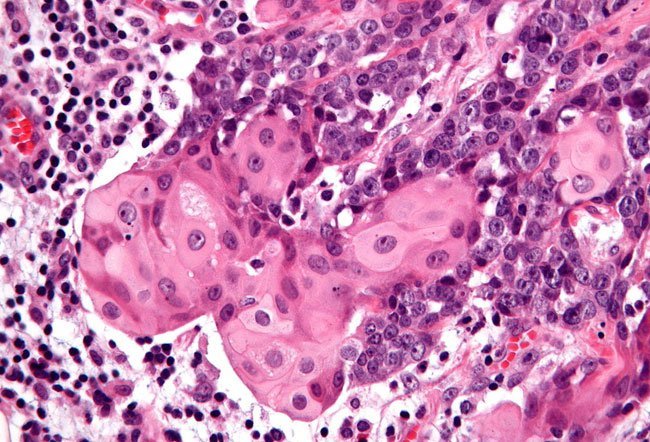 NUT carcinoma, also called NUT midline carcinoma, is a highly aggressive tumor arising due to abnormality in a gene called the NUT (nuclear protein in the testis) gene. NUT carcinoma may be curable when detected early.